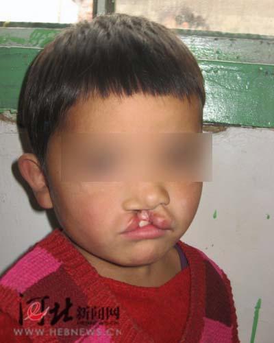 河北新闻网寻访第一位嫣然天使唇腭裂儿童