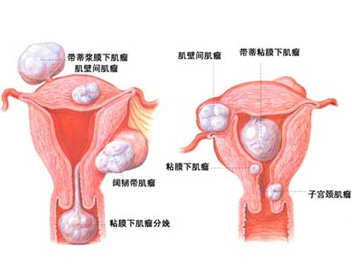 隐藏在痛经背后的疾病