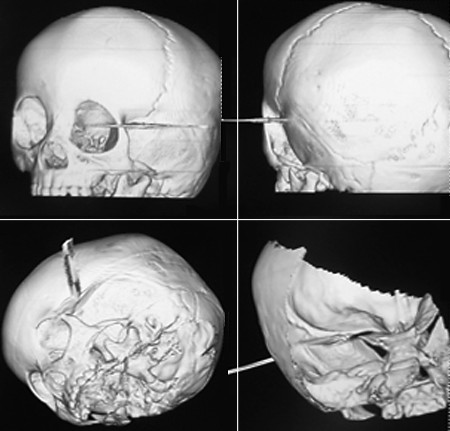 <em>毛衣钩针</em>刺进一龄童颅脑-<em>毛衣</em>,<em>钩针</em>,颅脑-新闻