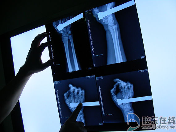 铁管刺透小伙手掌心 3小时手术保住断掌(图)