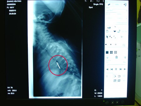 一岁女童吞下硬币  透视镜 前硬币清晰可见(图) 
