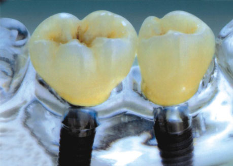 人工种植牙是怎么回事? 种植牙 烟台健康网 胶