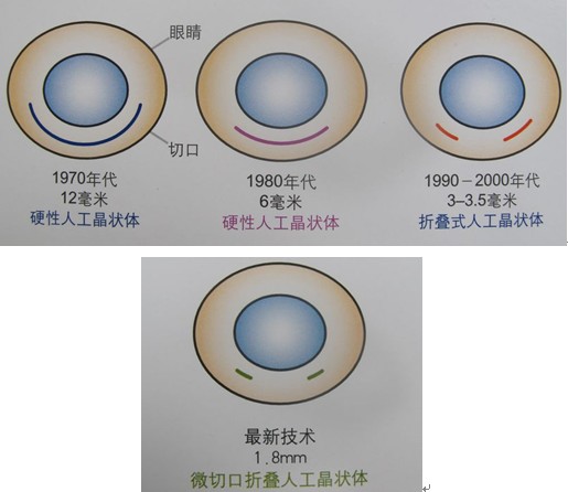 科医院成功完成1.8毫米微小切口白内障手术 烟