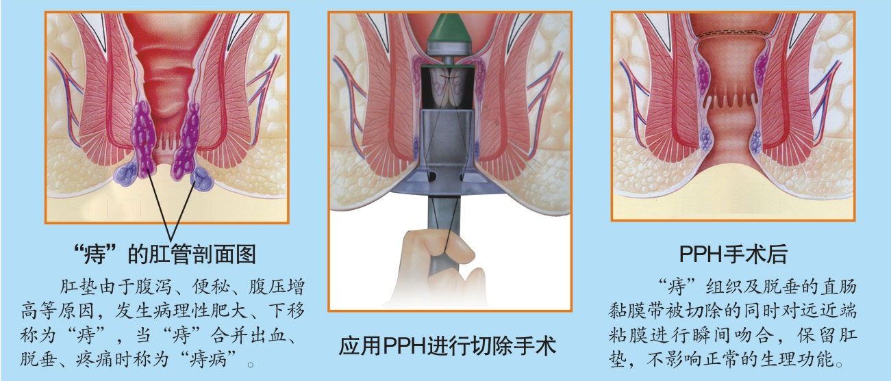 治疗痔疮最好的医院:什么样的治疗最有效果 _