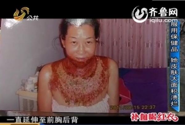 女子使用完美产品皮肤发生溃烂从脖子烂到乳房