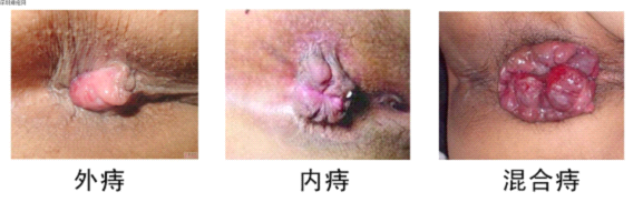 痔疮的症状是什么样子?
