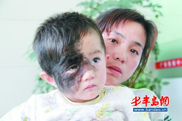 右脸黑斑不断长大生出毛发两岁女娃长出 猴