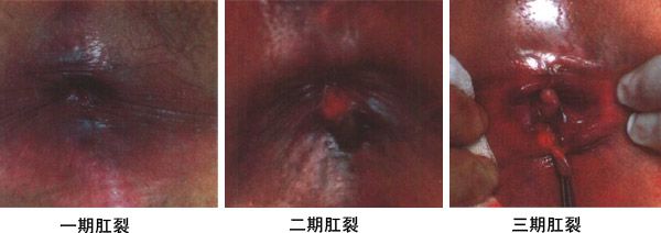 为什么<em>女性</em>更容易得<em>肛裂</em>_肛肠_烟台健康网_胶