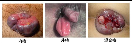 痔疮栓怎么用图解_痔疮怎么治