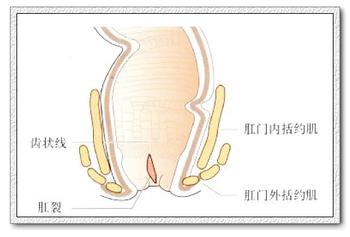 肛裂有哪些症状?有什么危害?