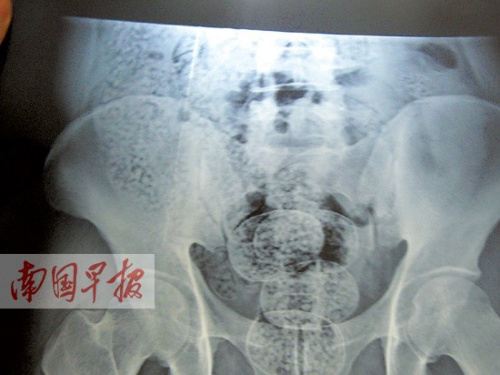 云南男子<em>肛门</em>内藏4000粒麻古 毒品在X光下现