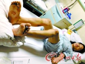 男子疑女友不忠<em>虐</em>两昼夜:烟头烫打火机烧(图) 
