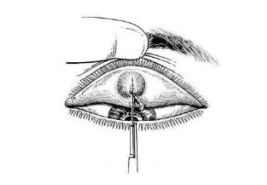 眼科专家告诉你:偷针眼到底是怎么回事?
