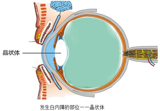 爱尔眼科医院一次手术同时解决高度近视 白内障