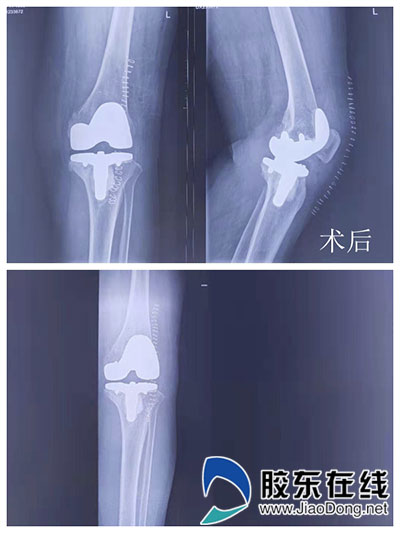 滨医烟台附院为七旬老人行复杂膝关节置换 术后2天即下床