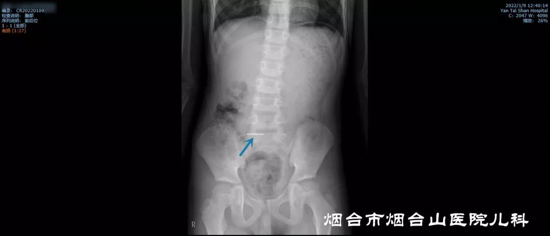 x线检查显示,患儿的中下腹部可见钉状金属密度致密影。