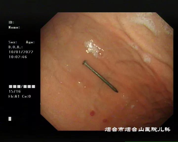 镜下可见患儿误吞的钢钉
