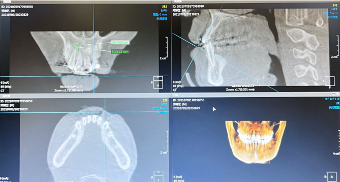 术后口腔cbct。(翻拍图片)