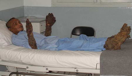 印尼"树人"有望恢复手脚功能(组图)