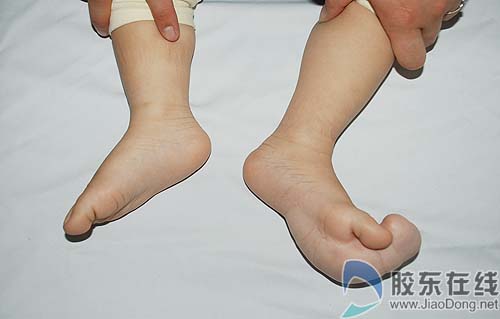 13月大男婴患巨足症 慕名来烟治罕症(图)
