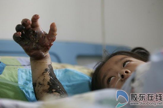 环境改善引来蛇出没烟台毒蛇一夜咬伤三人图