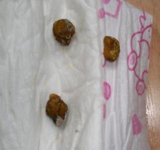 惠氏奶粉不达标致婴儿严重便秘报道后续(组图)