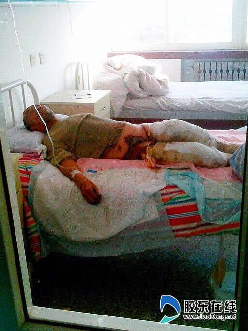 七旬独居老汉"煮"出灾难 重度烧伤无钱医治(图)