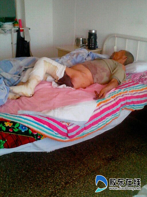 七旬独居老汉"煮"出灾难 重度烧伤无钱医治(图)