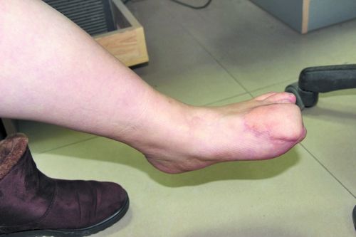 职工代表单位参加长跑比赛致残10年未获赔偿