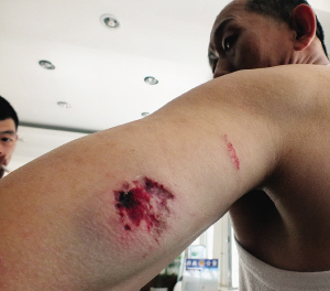 五青年打一辆车遭拒 一女子咬掉的哥胳膊一块肉_新闻聚焦_网上问法