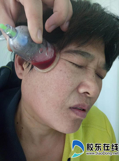 中医刺络放血疗法多年的神经性头疼好了