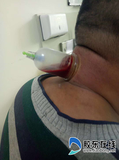 中医刺络放血疗法多年的神经性头疼好了