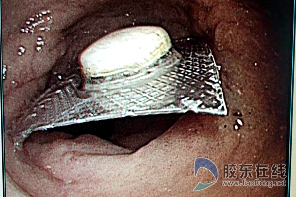 险烟台一老汉服药未拆包装一并吞入伤了胃