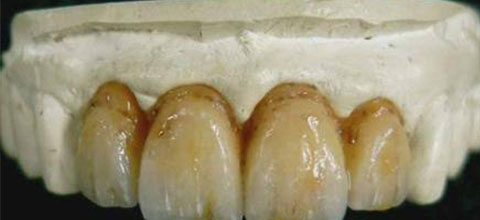 牙齿发黄怎么处理胶东半岛口腔医院告诉您