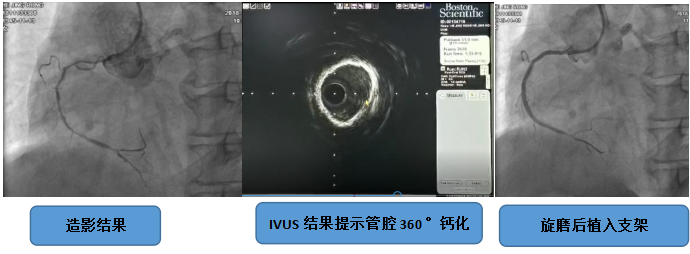 血管内超声（IVUS）在冠状动脉介入治疗中的临床应用_烟台健康资讯_烟台健康网_胶东在线