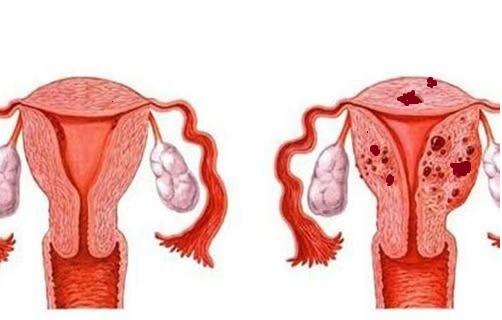 图:左为正常子宫肌层   右为子宫腺肌子宫,肌层内弥漫病灶